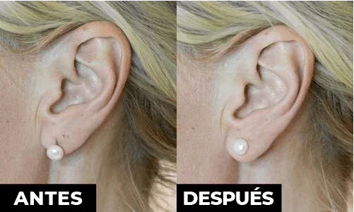 Levantador de Aretes